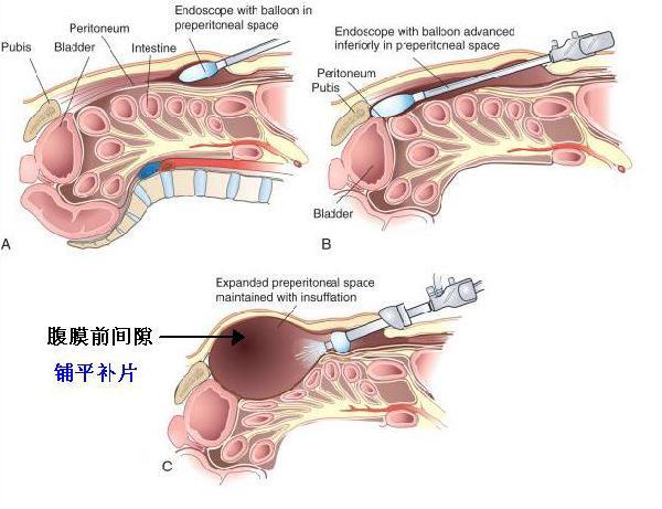 臨床表現腹股溝疝是最常見的疝,突出的鼓包發生在腹股溝處;臍疝的突出