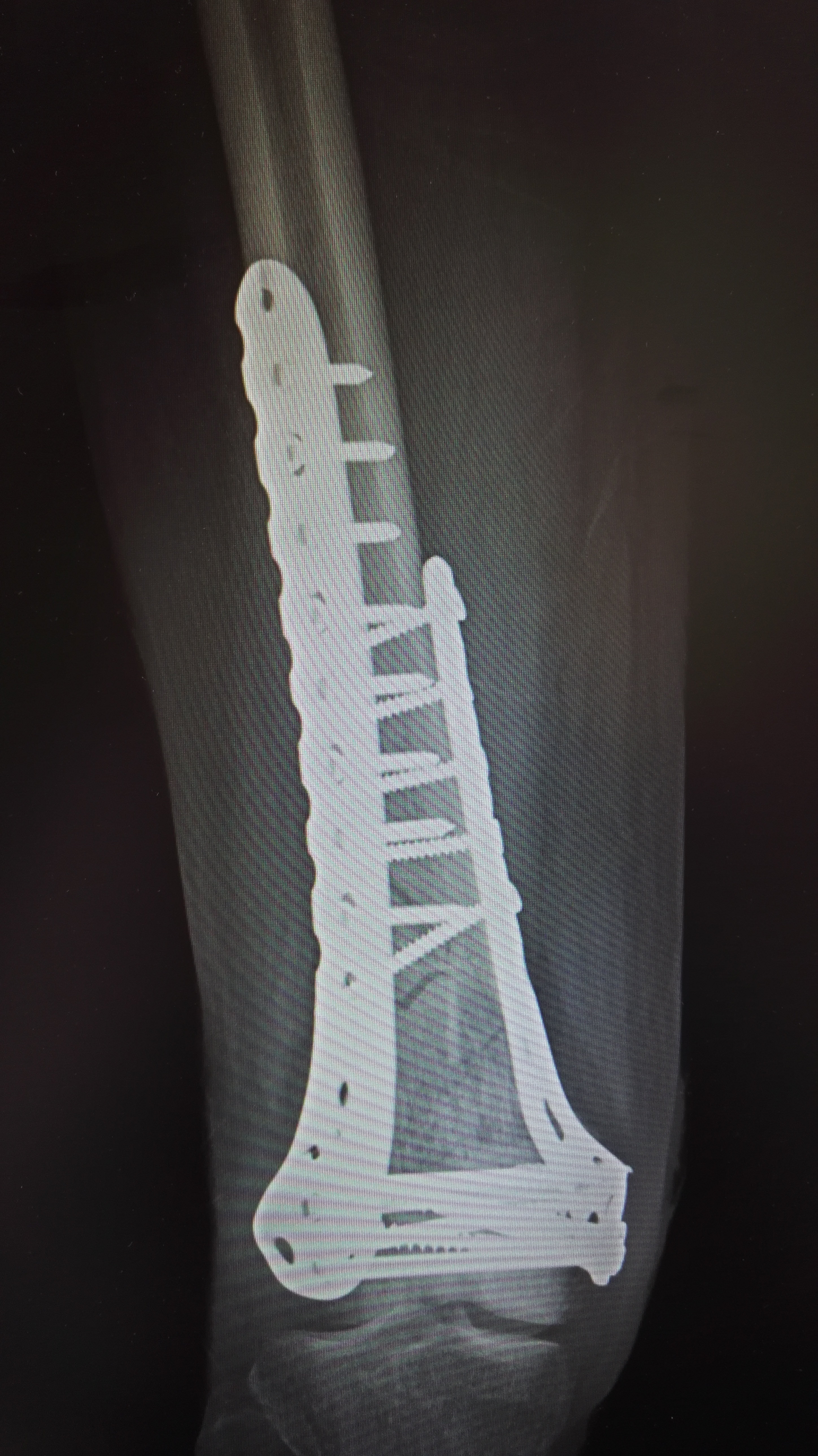 下肢股骨远端骨折1例,伴髌骨骨折 - 好大夫在线