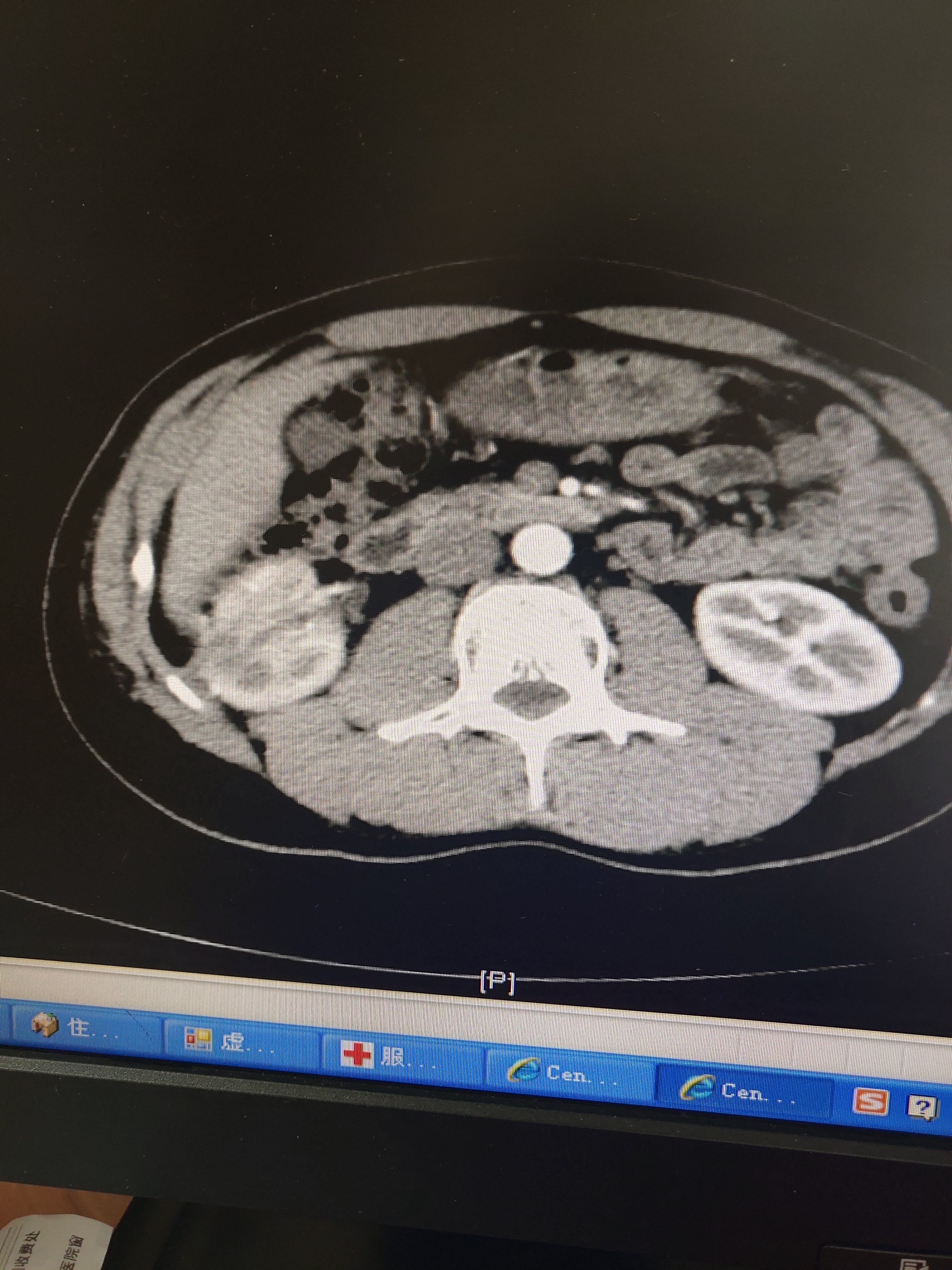 右肾5cm肿瘤行后腹腔镜保肾手术.术后3个月肾功恢复良好 - 好大夫在线