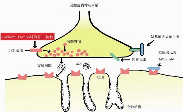 重症肌无力生活及饮食注意点_重症肌无力_营养与饮食_日常注意事项