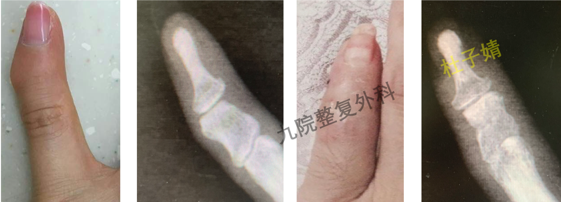 小指畸形 Kirners畸形和手指侧偏畸形 先天性骨与关节畸形 先天性骨与关节畸形 小指畸形 Kirners畸形和手指侧偏畸形 先天性骨与关节畸形 先天性骨与关节畸形