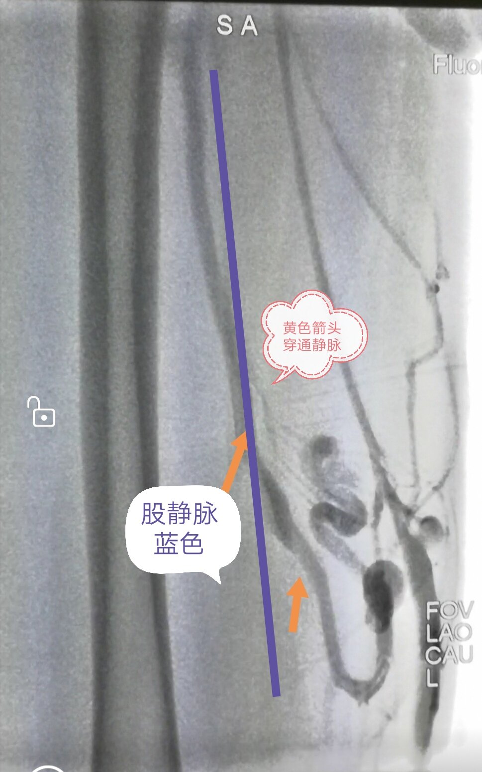 穿通支静脉闭合术