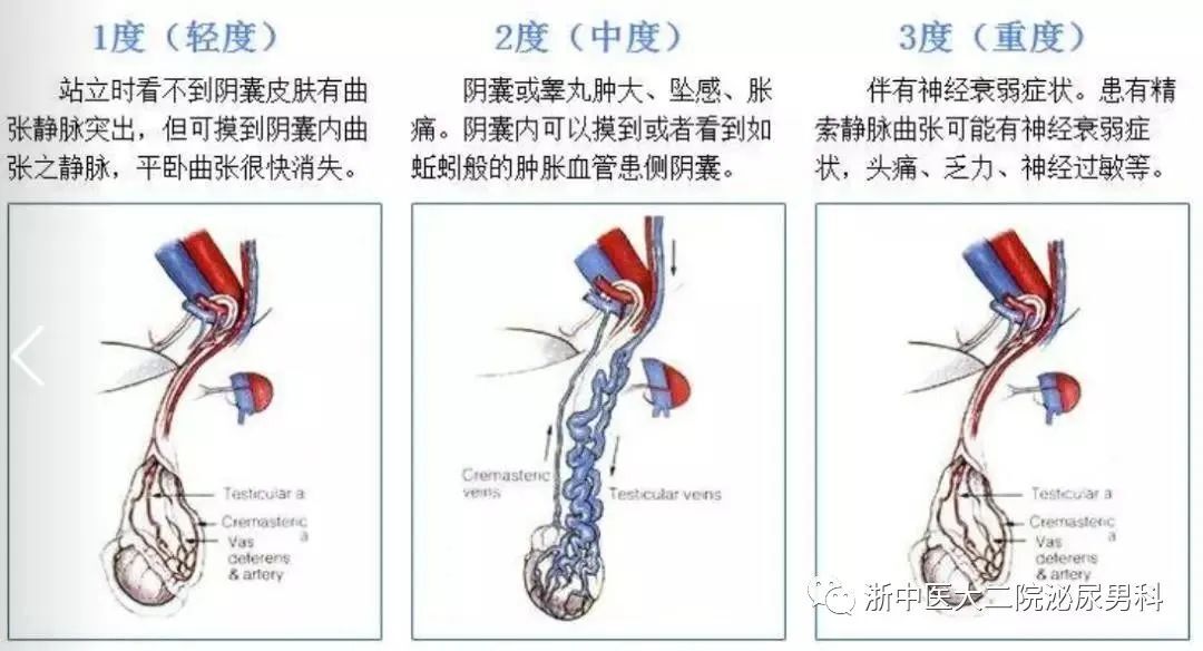 由于精索静脉曲张能够对睾丸产生明显的不良影响,可以造成男性的精液