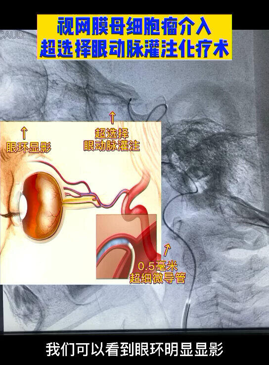 视网膜母细胞瘤介入保眼治疗
