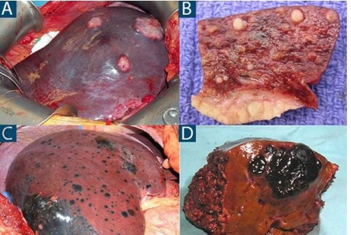 肿瘤是如何转移的_直肠癌_直肠癌介绍 - 好大夫在线