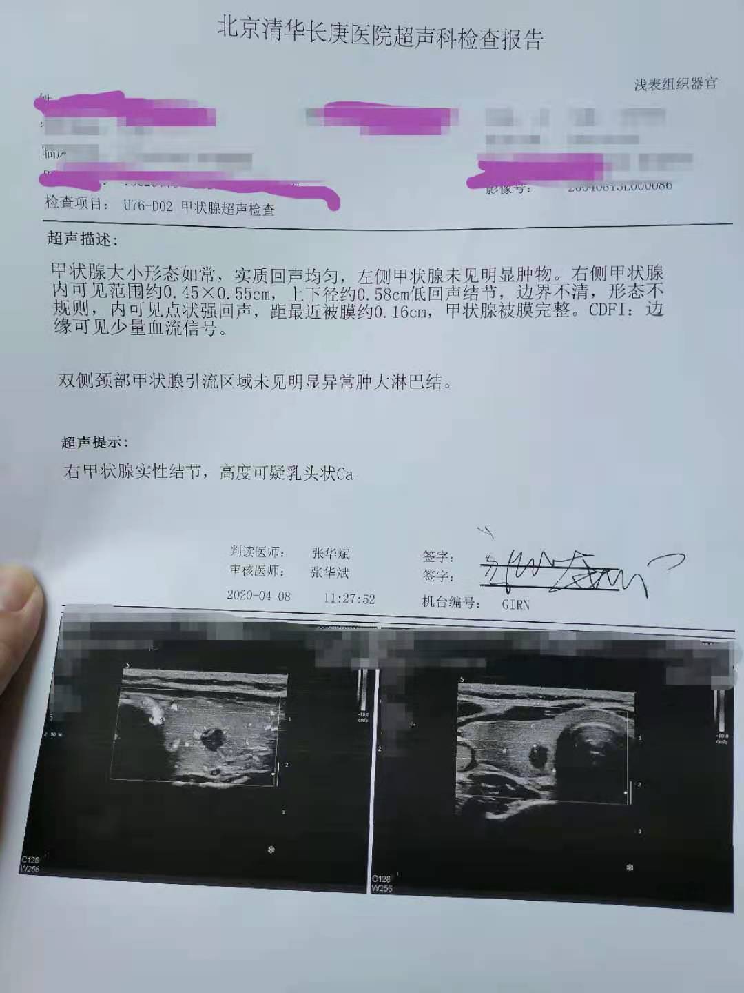 甲状腺腺瘤彩超图片图片