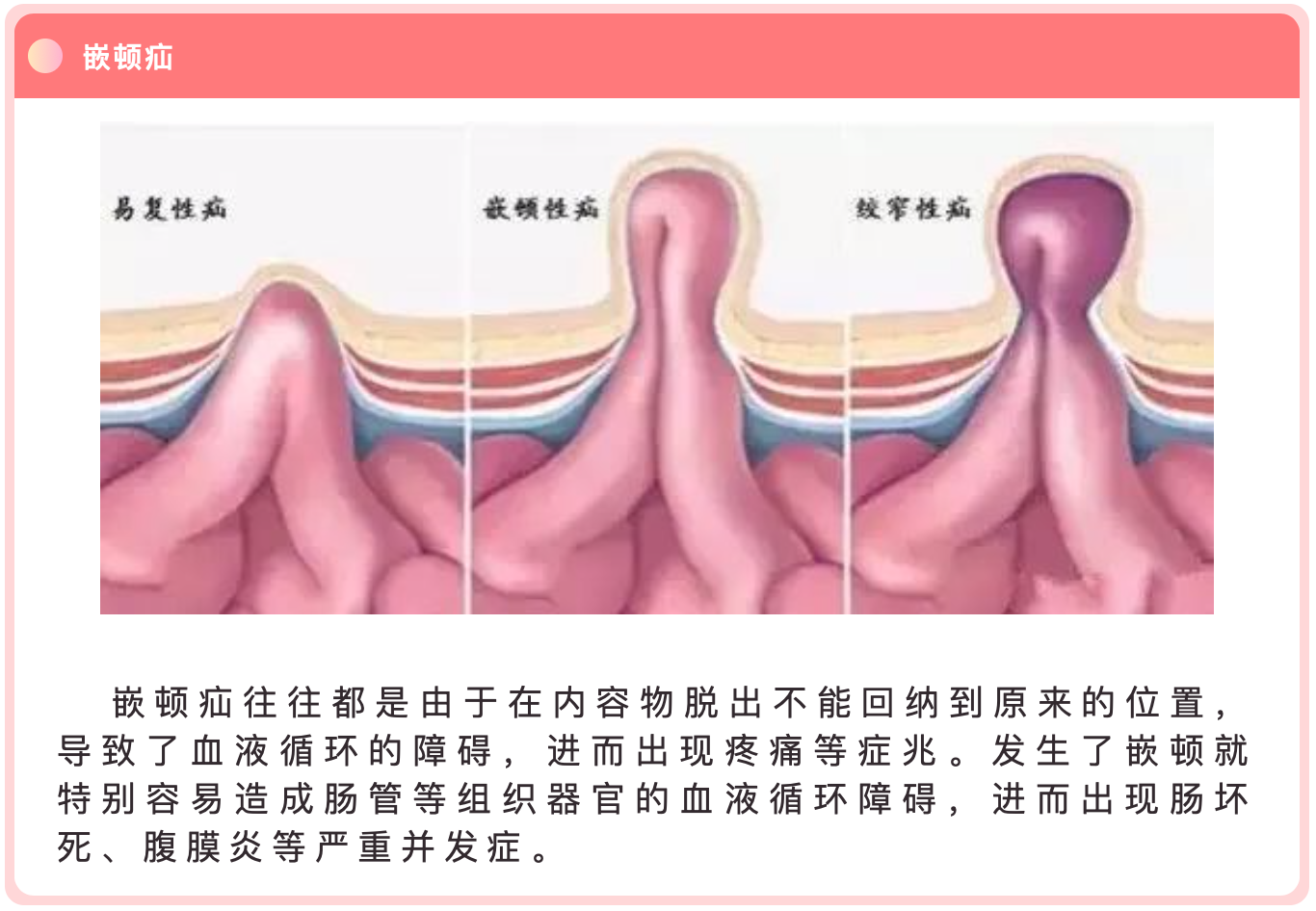 不及時治療疝氣腸子都悔死了