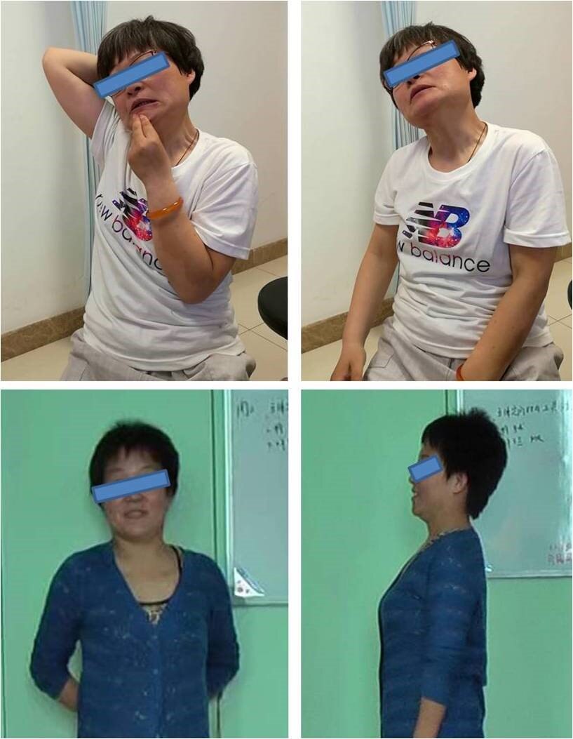 痉挛性斜颈的脑起搏器(dbs)治疗