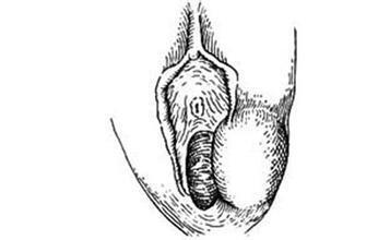 前庭大腺脓肿切开术图片