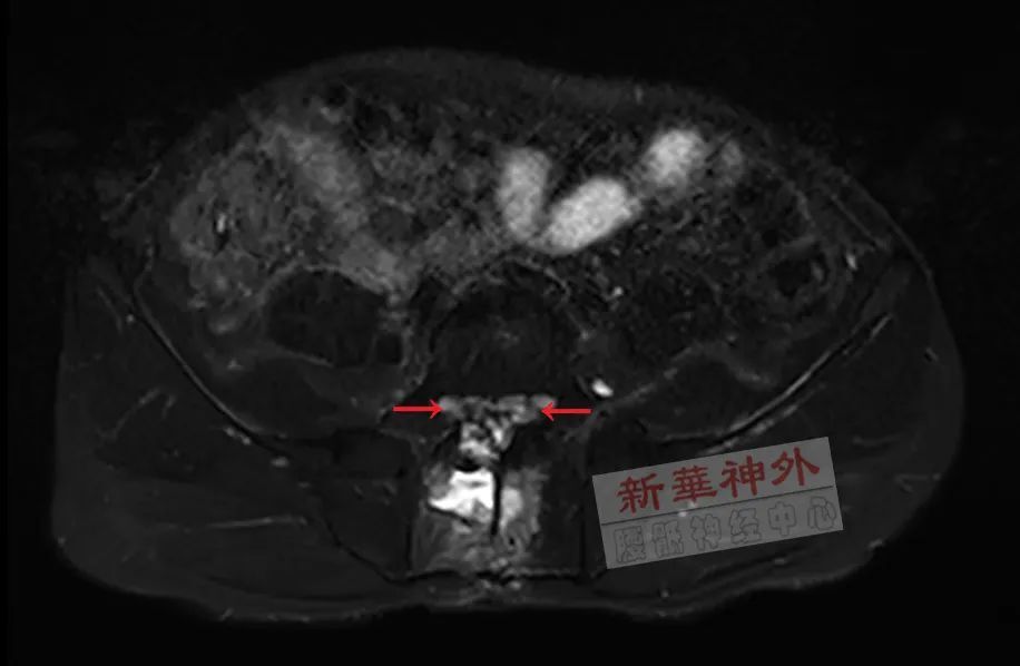 骶管囊腫文獻導讀神經根囊腫引起的坐骨神經痛