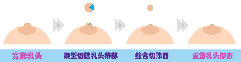 哺乳后乳房衰老三联征之乳头肥大:乳头缩小术