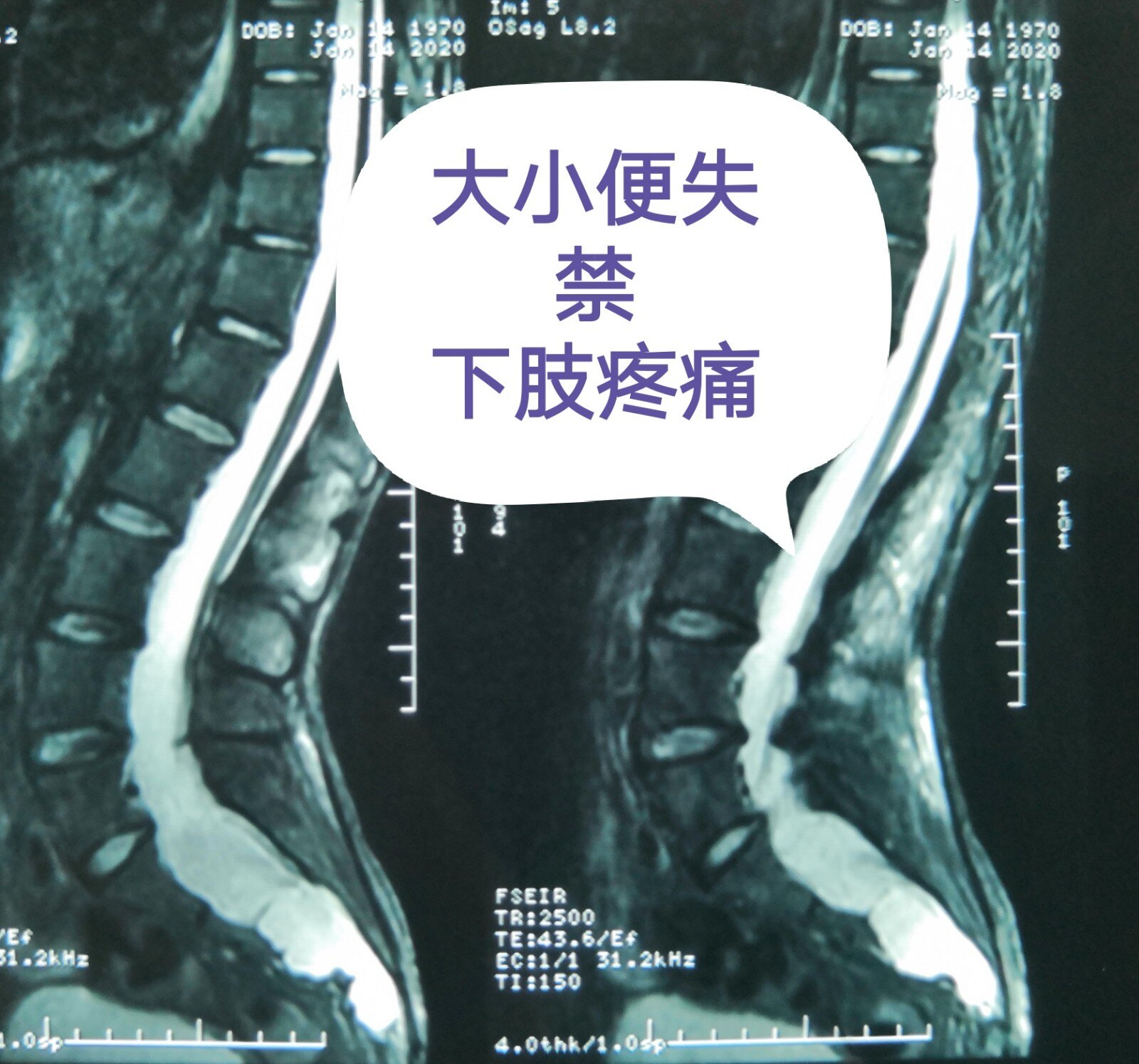 大小便失禁伴下肢疼痛原來是骶管囊腫合併脊髓栓系惹的禍