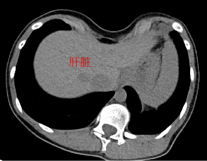 重度漏斗胸合併脊柱側彎超微創手術治療