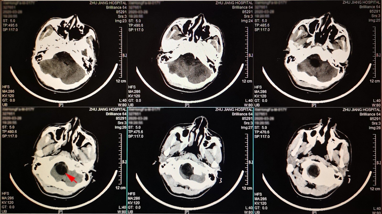 一例Ⅱ型神经纤维瘤病患者的5次手术治疗(一) 