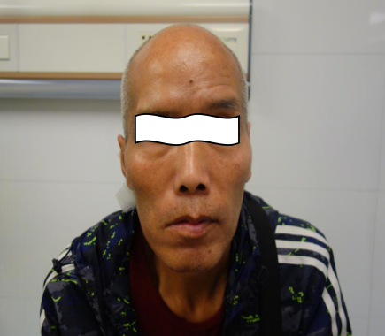 面瘫后遗症----面部肌肉连带运动_面瘫_介绍_症状表现 - 好大夫在线