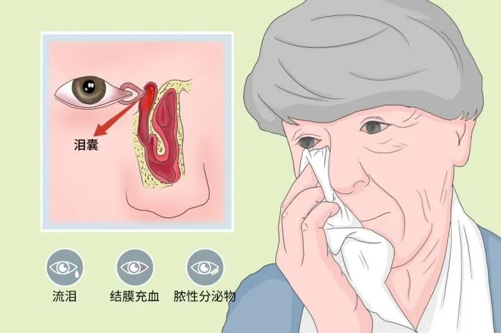 泪道阻塞_介绍_症状表现_治疗方式 - 好大夫在线