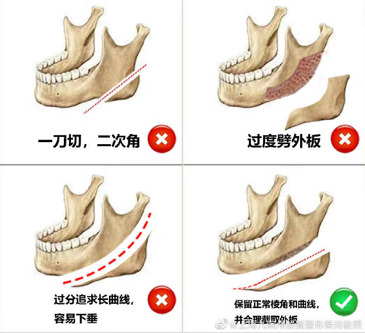 下頜角手術截骨都是什麼形狀的呀