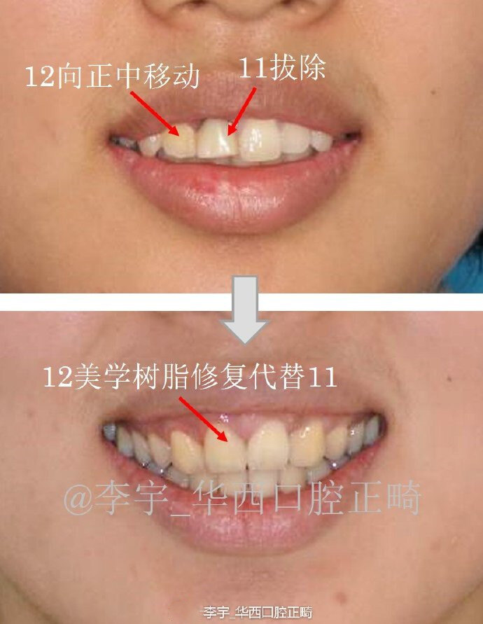 今日案例分享---#拔切牙正畸#_牙颌畸形_牙颌畸形治疗方式 - 好大夫