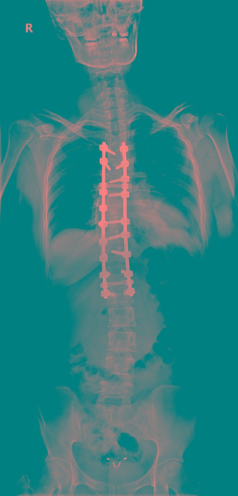 先天性脊柱侧弯在生下来以后就有脊柱发育畸形,半椎体畸形,蝴蝶椎或者