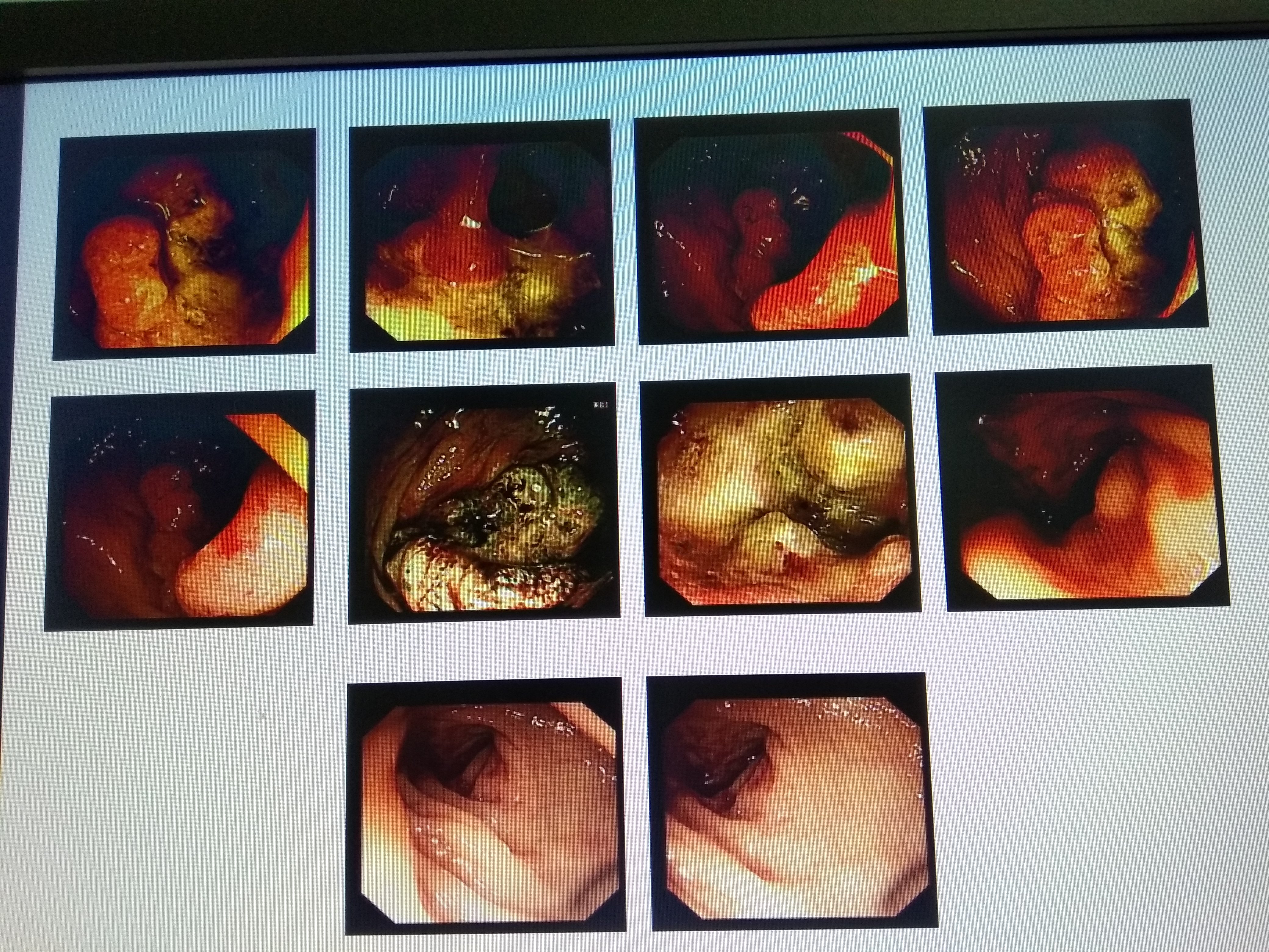 早期直肠癌肠镜图片图片