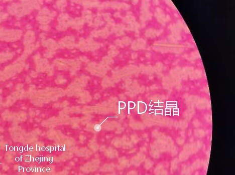 假痛风性关节炎 (pseudogout arthritis)_痛风_相关疾病_介绍 - 好大