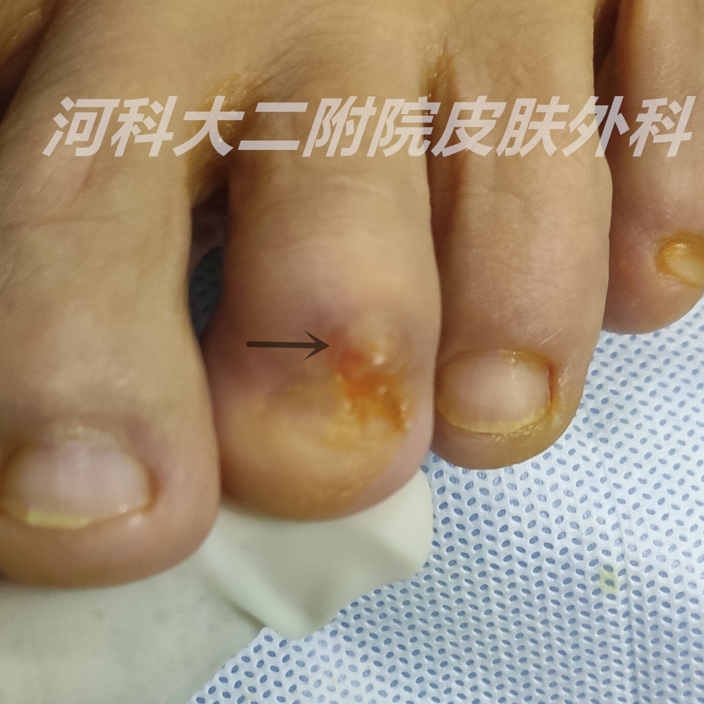 指 趾 末端突起的小鼓包 粘液性囊肿的前世今生 粘液囊肿 粘液囊肿