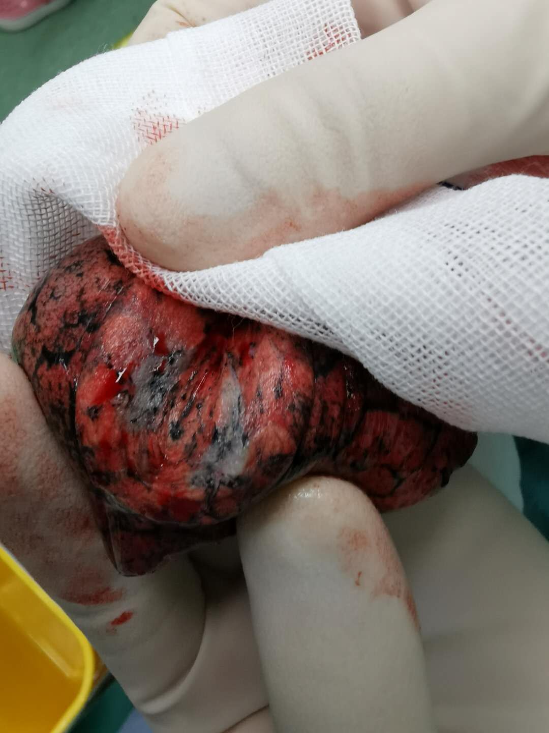 右肺上叶前段磨玻璃结节,术中冰冻病理证实为癌 - 好大夫在线