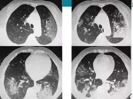 儿童腺病毒感染有什么表现_急性上呼吸道感染_发病原因_症状表现 - 好