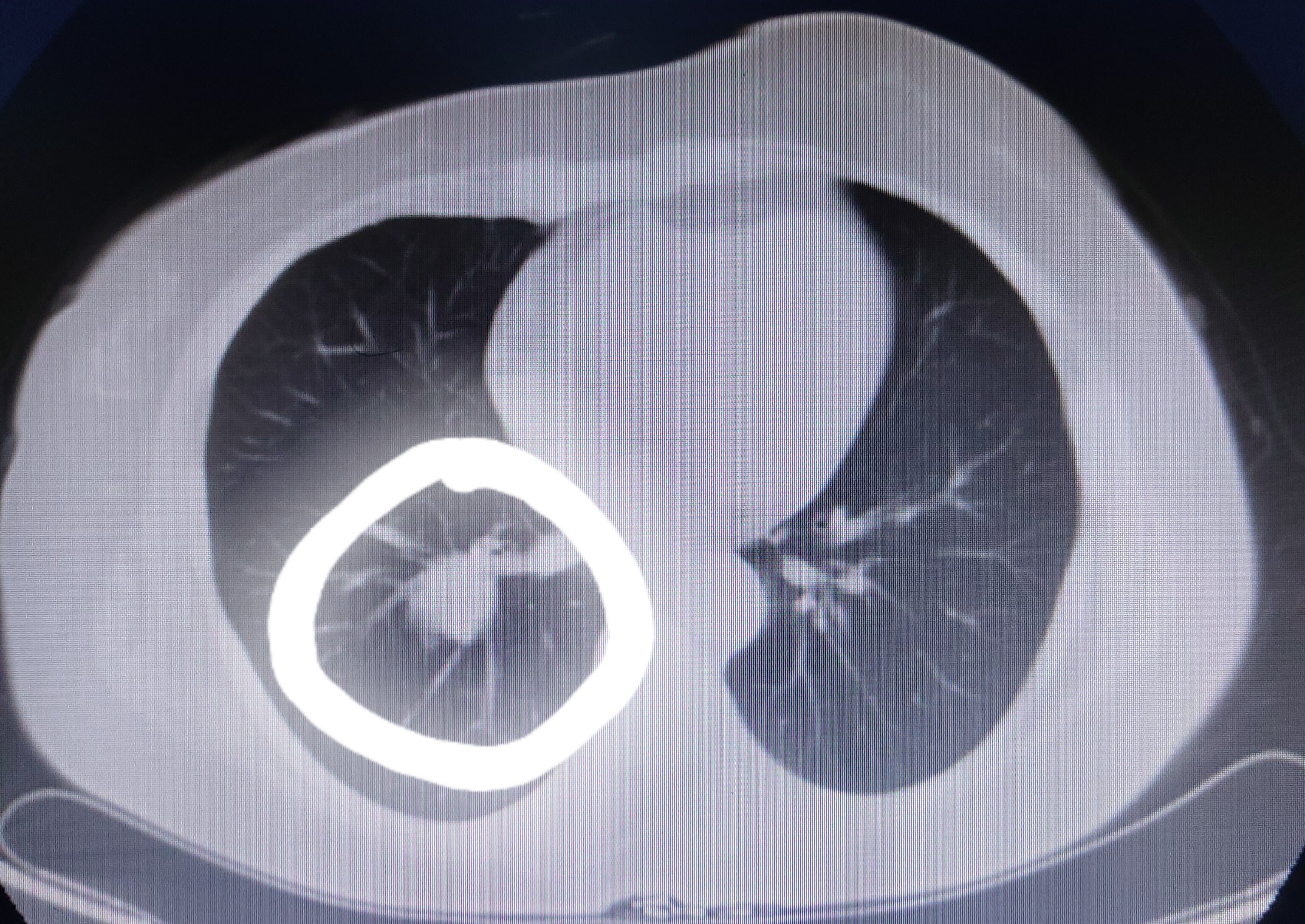 刘懿博士说肺癌(一亖三〇)从别的科出院,胸部ct报告一定要读一下