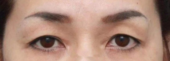 6 7年前割过双眼皮 现在眼皮松了 做提眉还是全切双眼皮 双眼皮修复 双眼皮修复 6 7年前割过双眼皮 现在眼皮松了 做提眉还是全切双眼皮 双眼皮修复 双眼皮修复