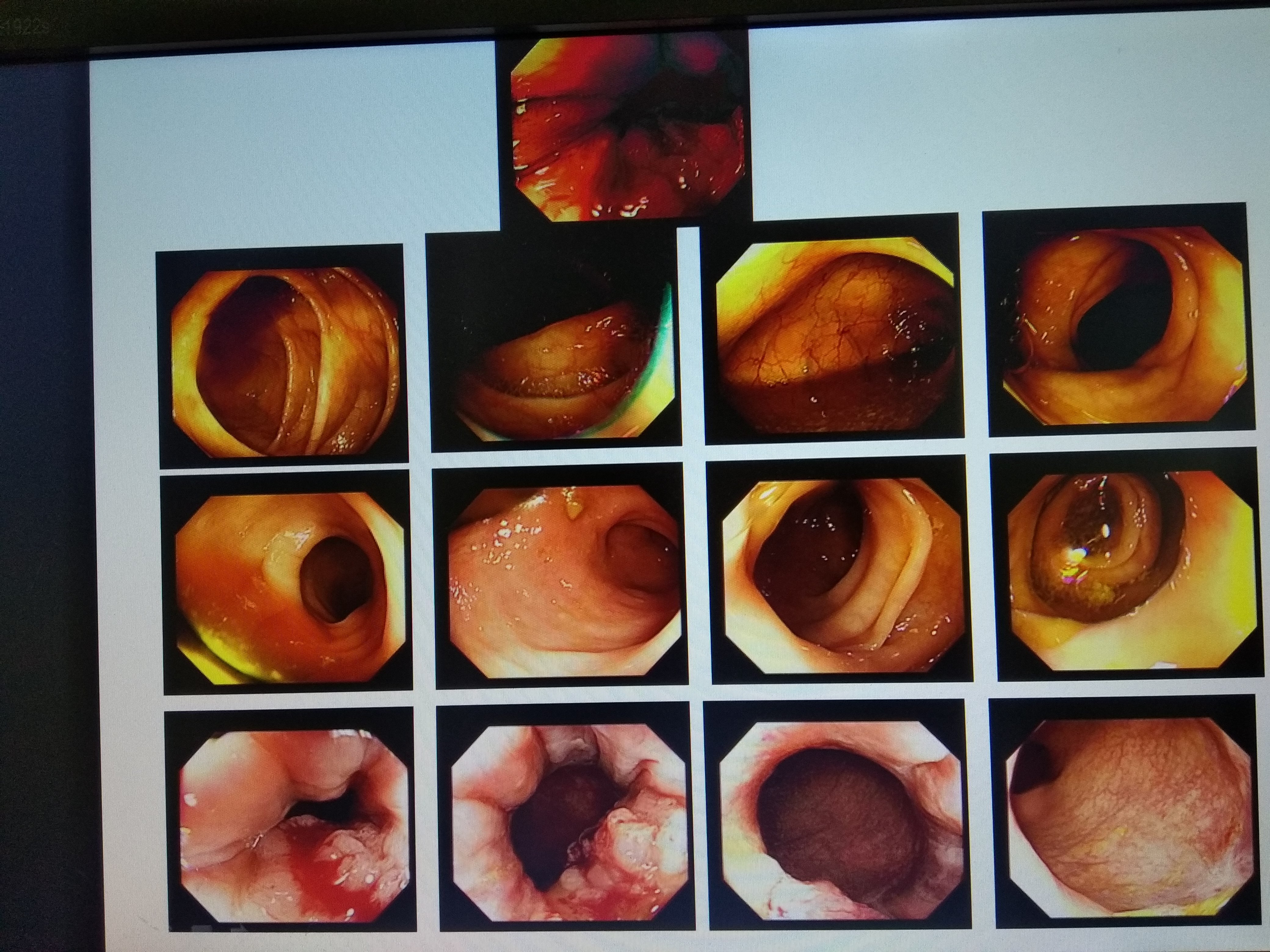 应重视肠镜检查,防止结肠息肉,结肠癌,直肠癌等引起的便血(三) - 好