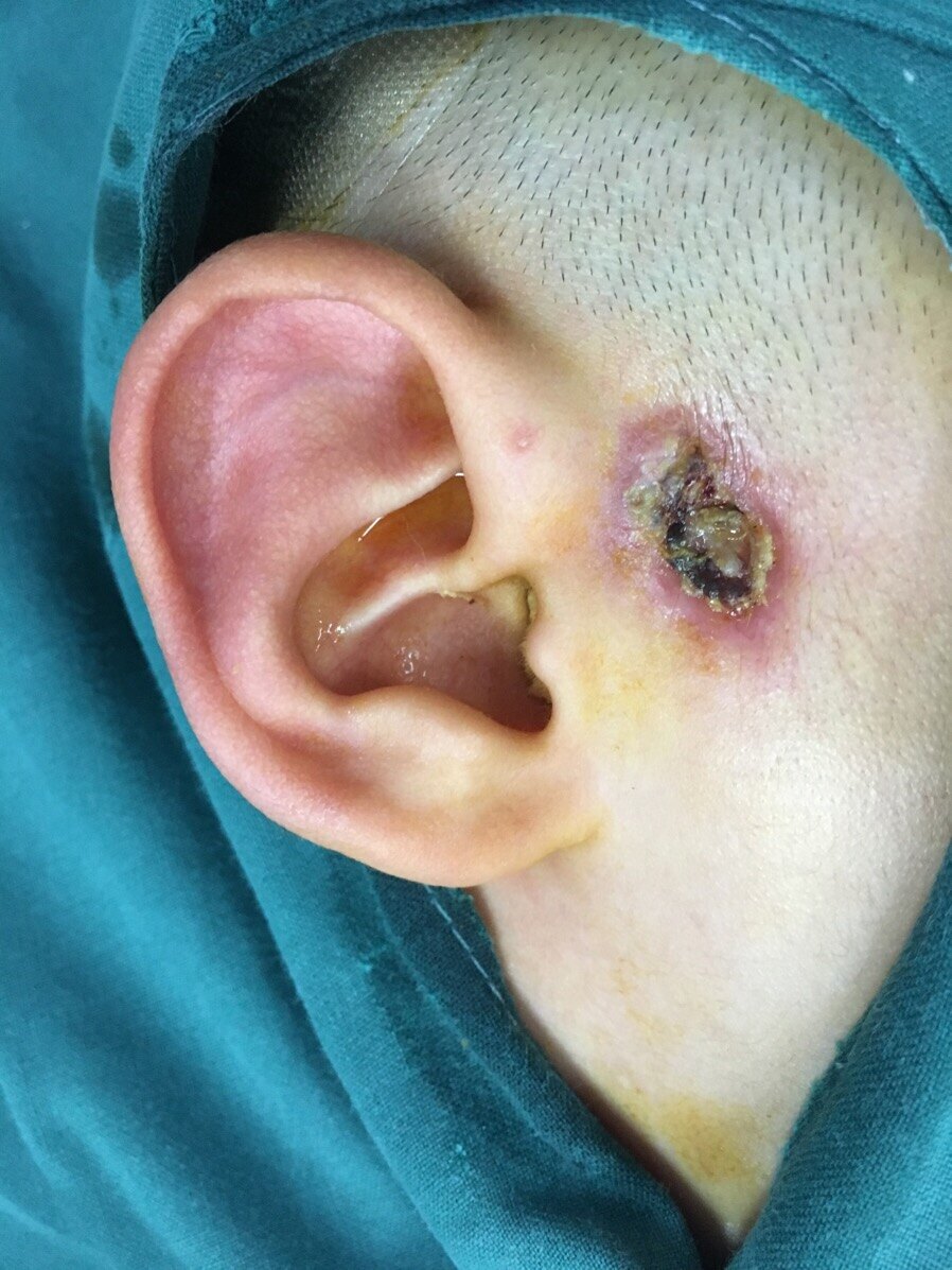 耳前瘘管感染期可以手术吗