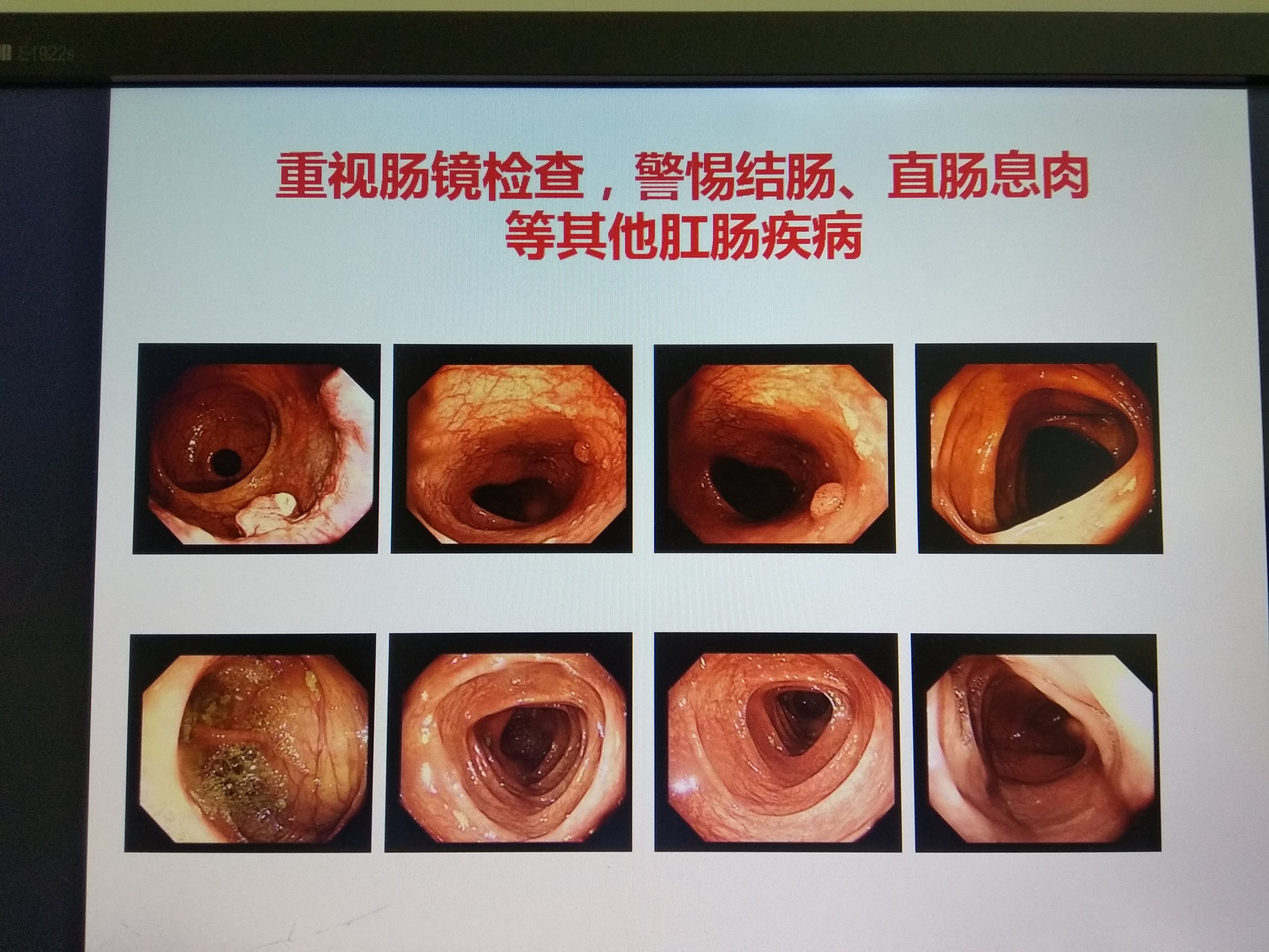 直肠腺癌图片肠镜图片