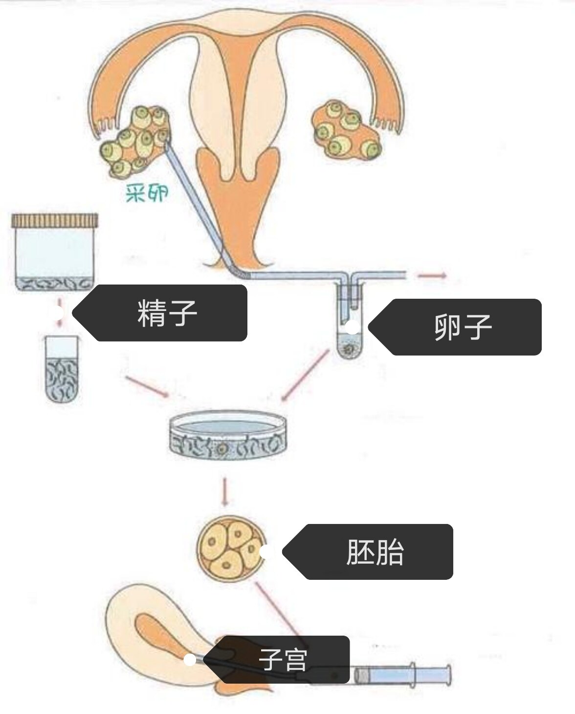 体外受精