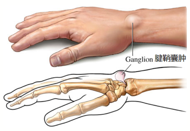 腕部腱鞘囊肿,除了挤破穿刺,开放手术,微创关节镜手术了解一下!