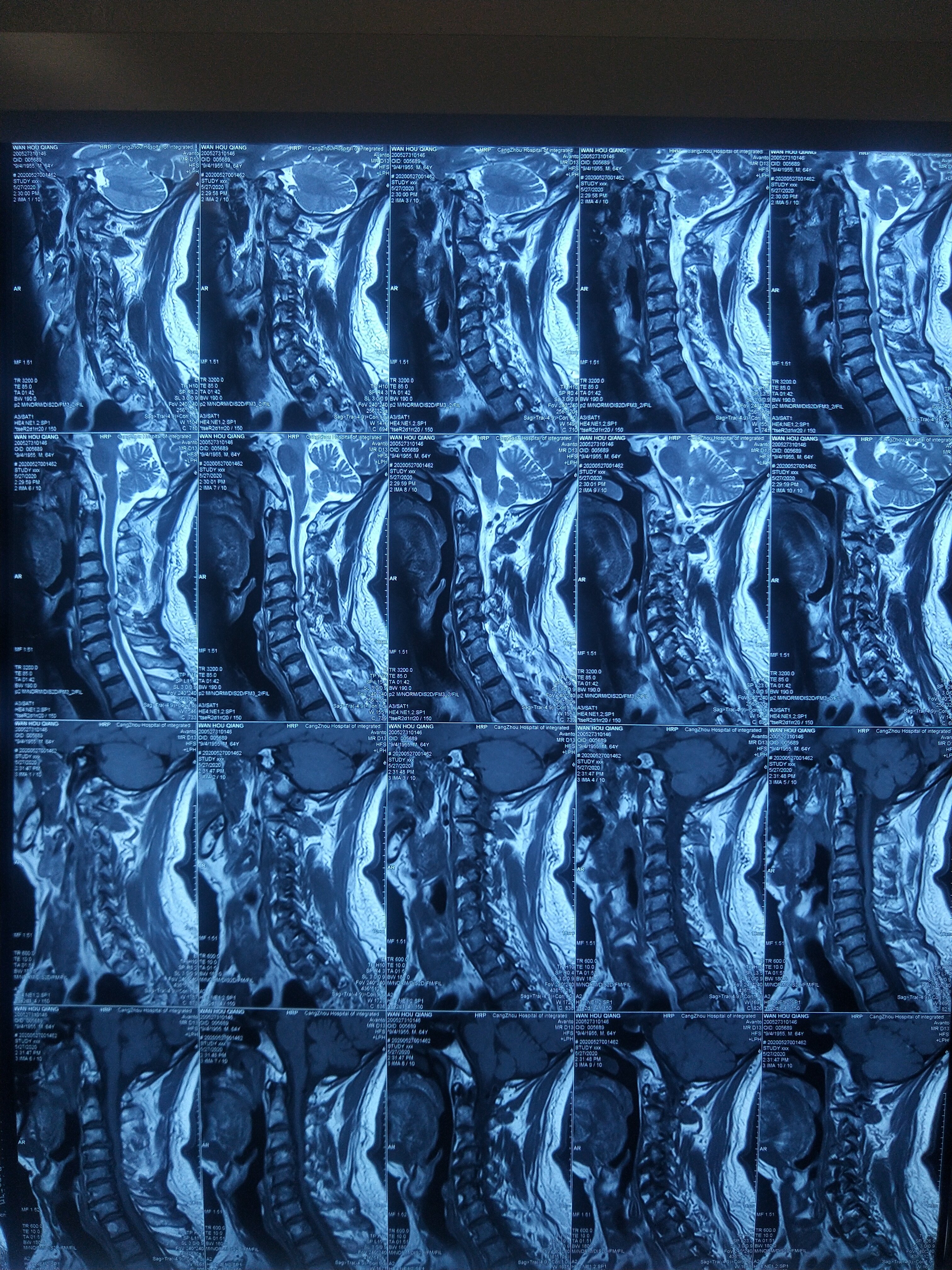 椎动脉型颈椎病x光片图片
