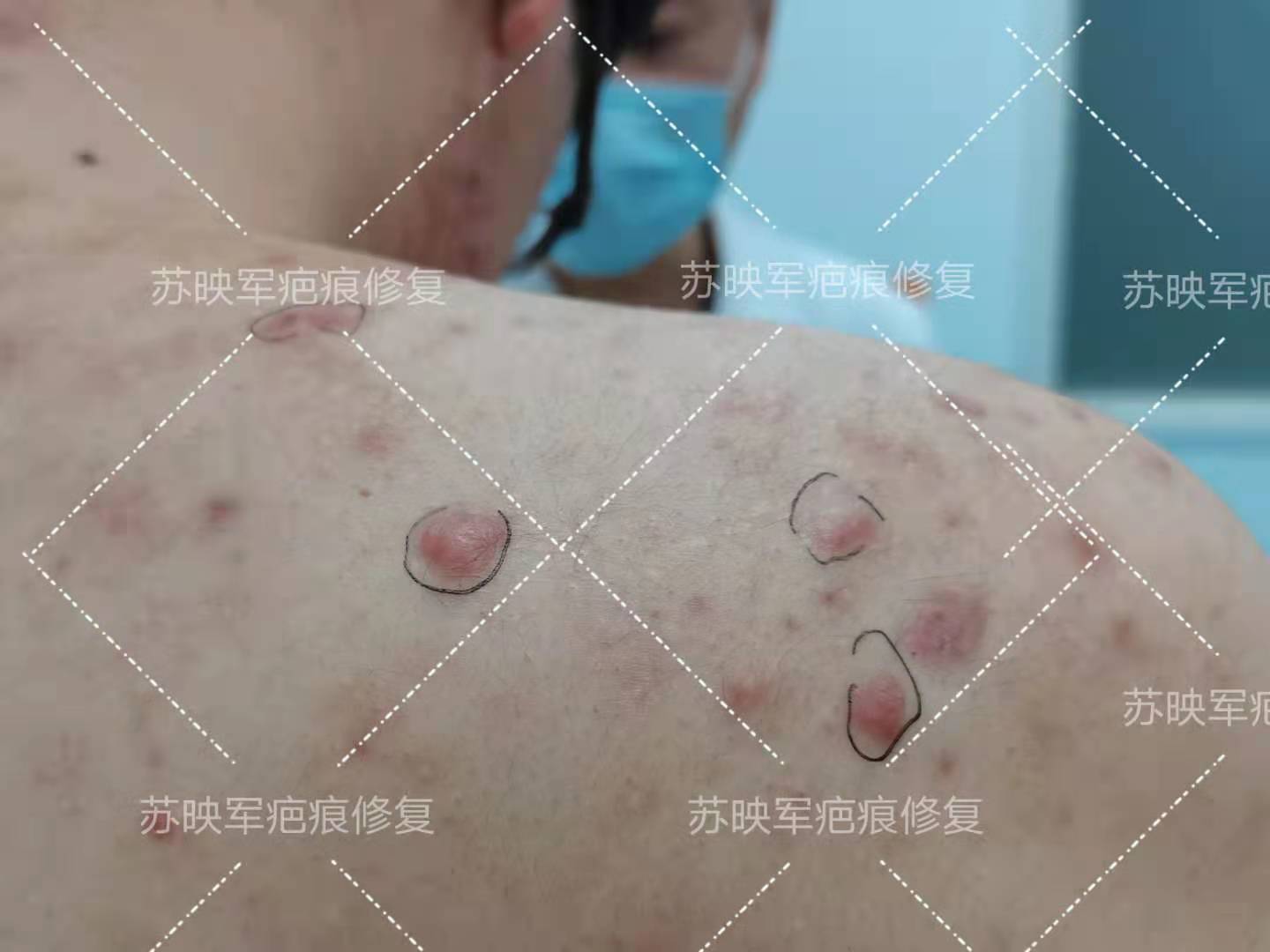 怎么知道自己是普通的痘痘还是瘢痕疙瘩?_痤疮 - 好大夫在线