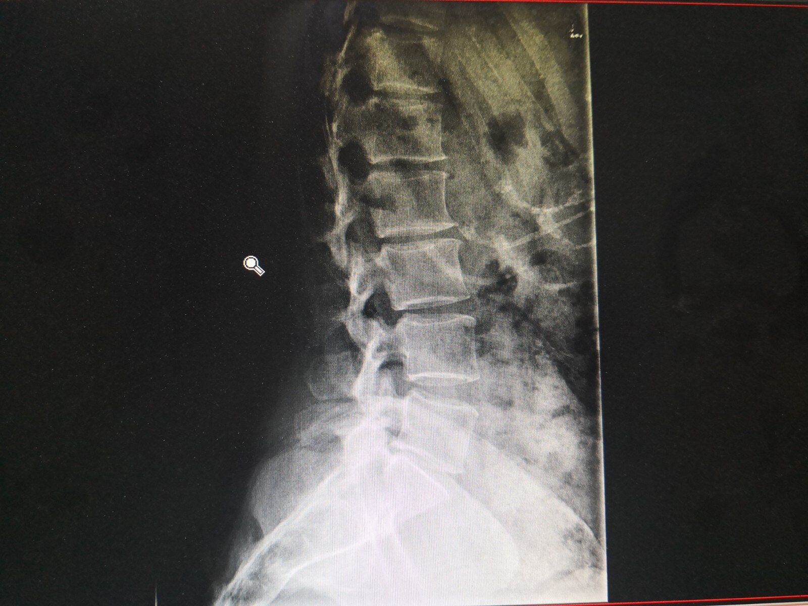 腰椎正側位片:腰椎骨質增生,腰5骶1椎體後緣骨質增生,椎間隙變窄.