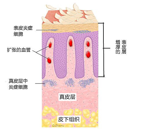 顽固性银屑病(牛皮癣)是谁的锅?——什么原因会导致银屑病?