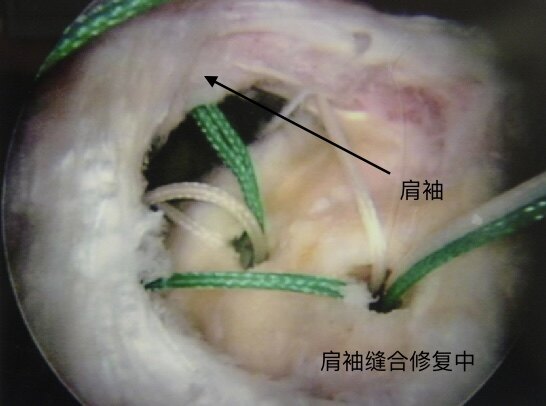 肩袖损伤症状图片