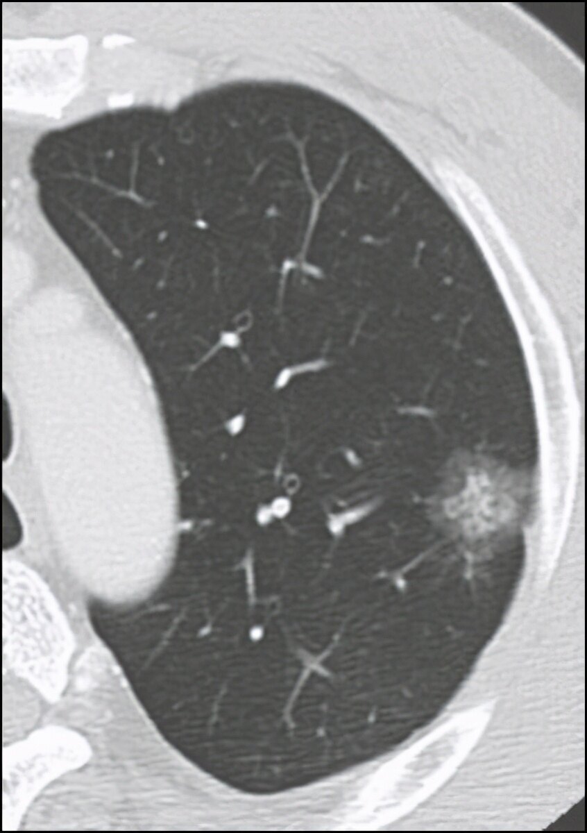 肺上发现磨玻璃结节,是做微创手术好,还是微波介入治疗好?