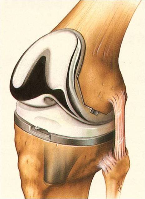 保膝手术-膝关节单髁置换术并发症那些事_人工关节置换术_人工关节