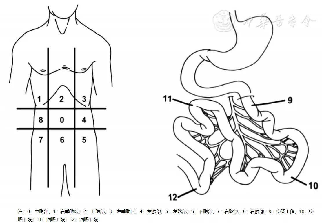 cancer index,pci)評估腫瘤負荷及播散程度,pci評估的腹部分區示意圖