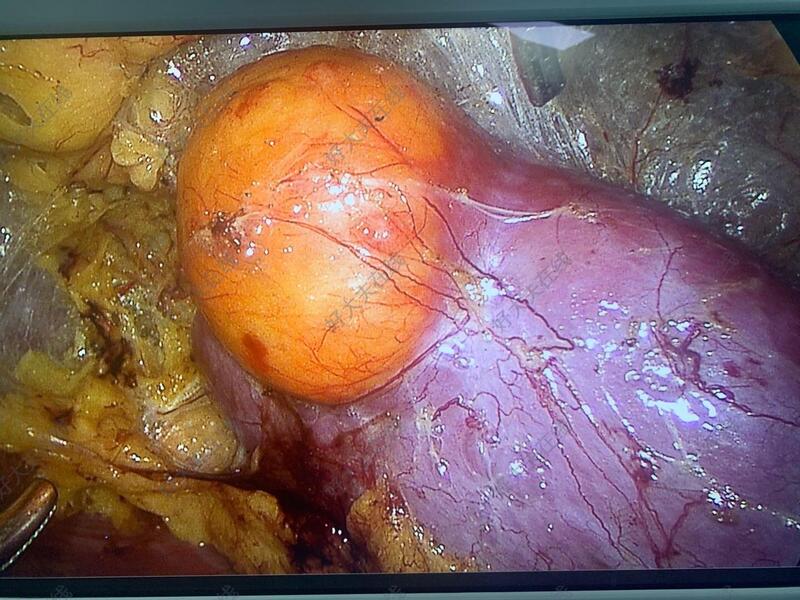 肾构瘤图片