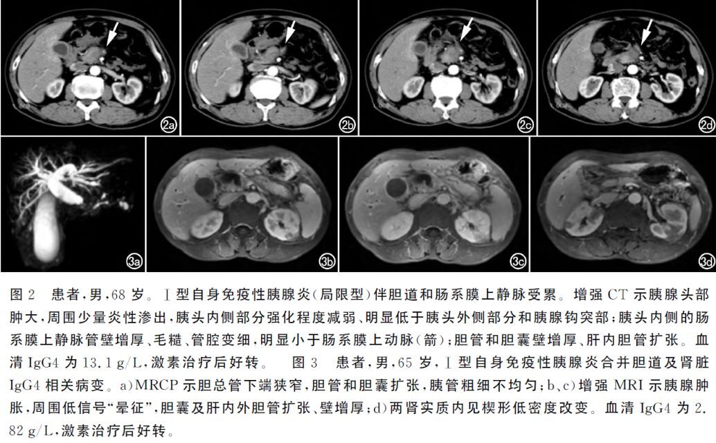 一種較少見的胰腺病igg4相關自身免疫性胰腺炎