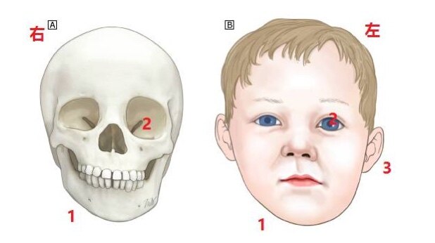 婴儿斜颈的症状表现图片