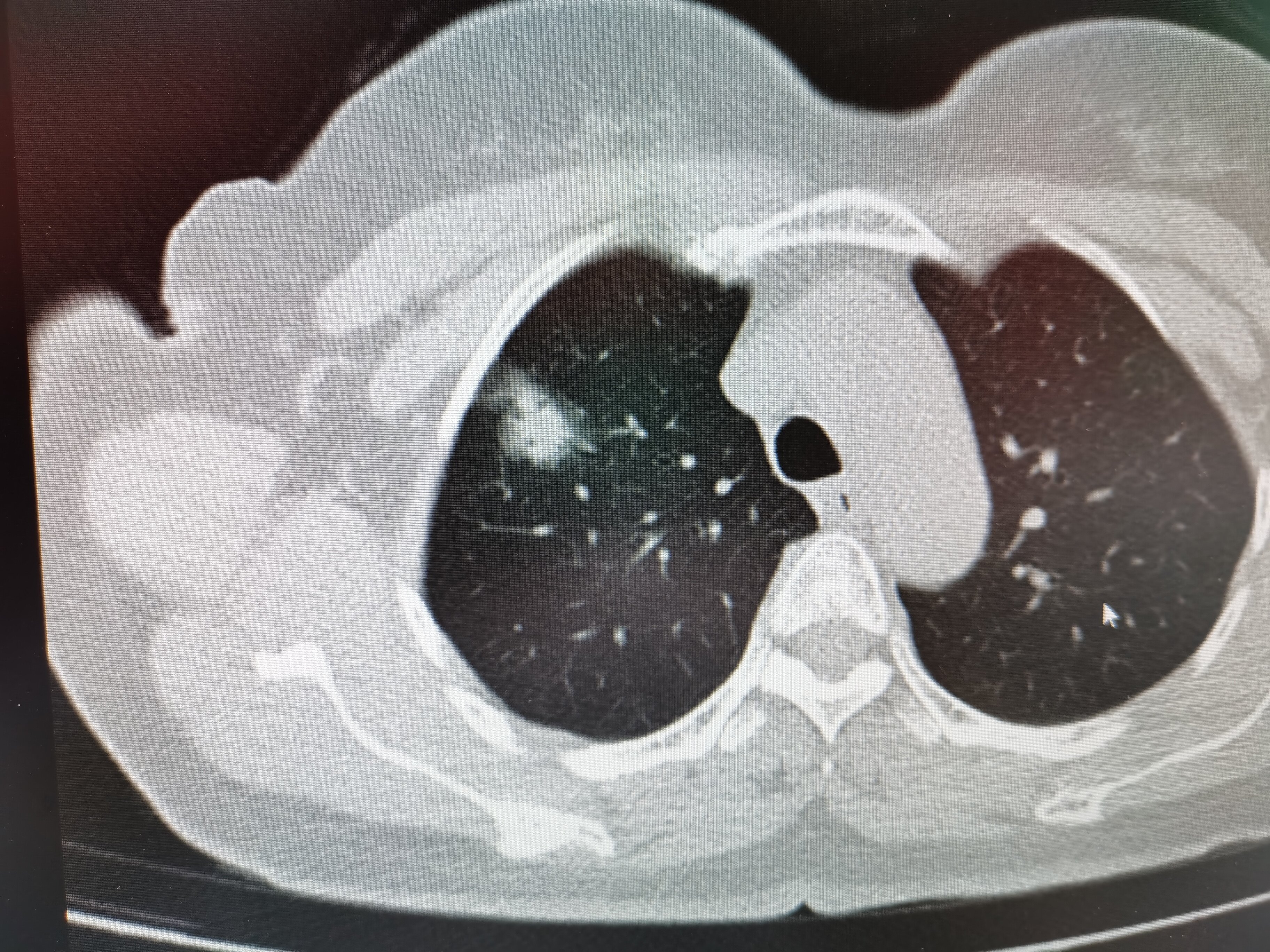 肺癌ct照片图片