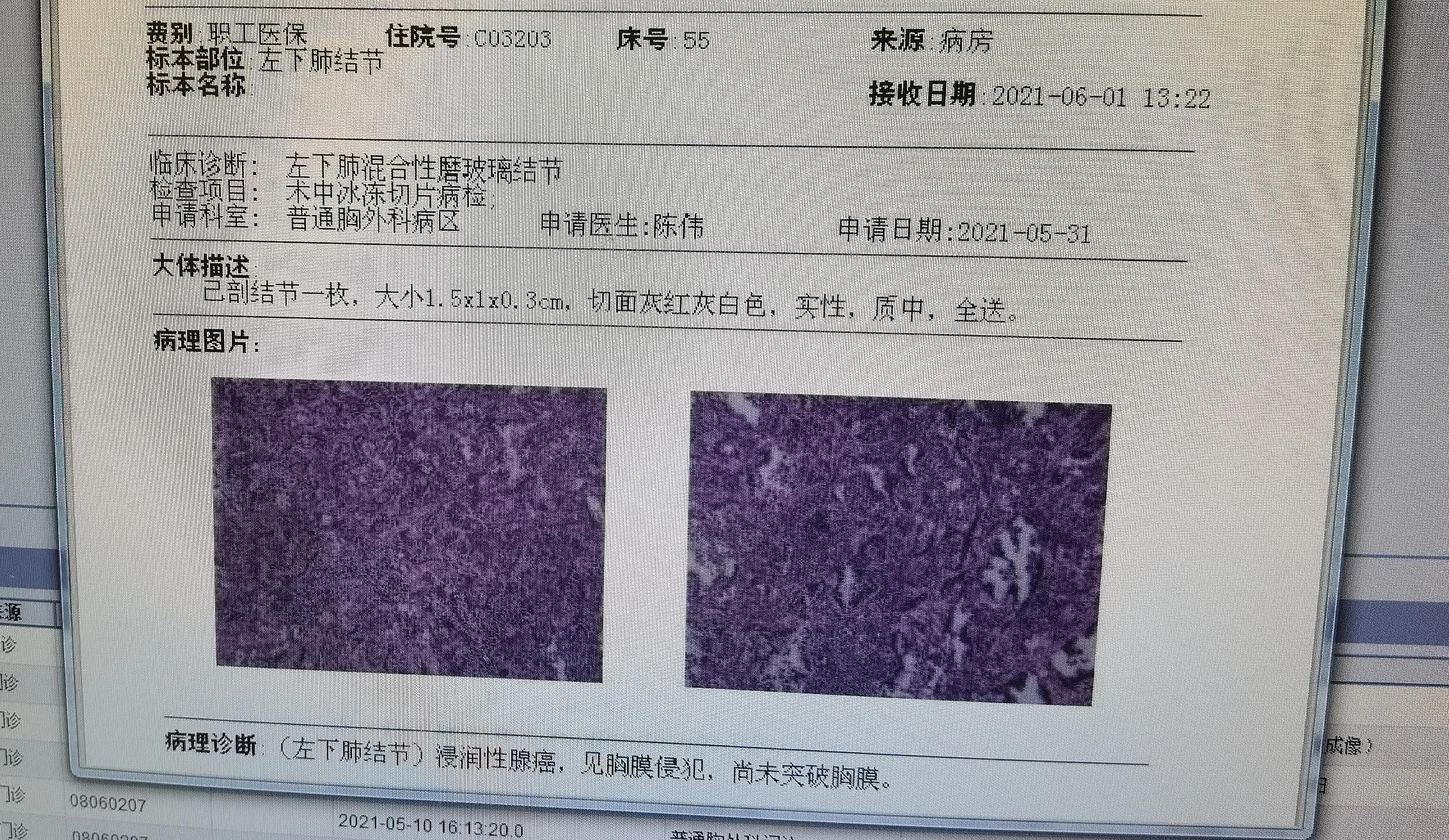 磨玻璃結節型肺癌嚴重嗎10mm磨玻璃結節不長大就沒有危險嗎