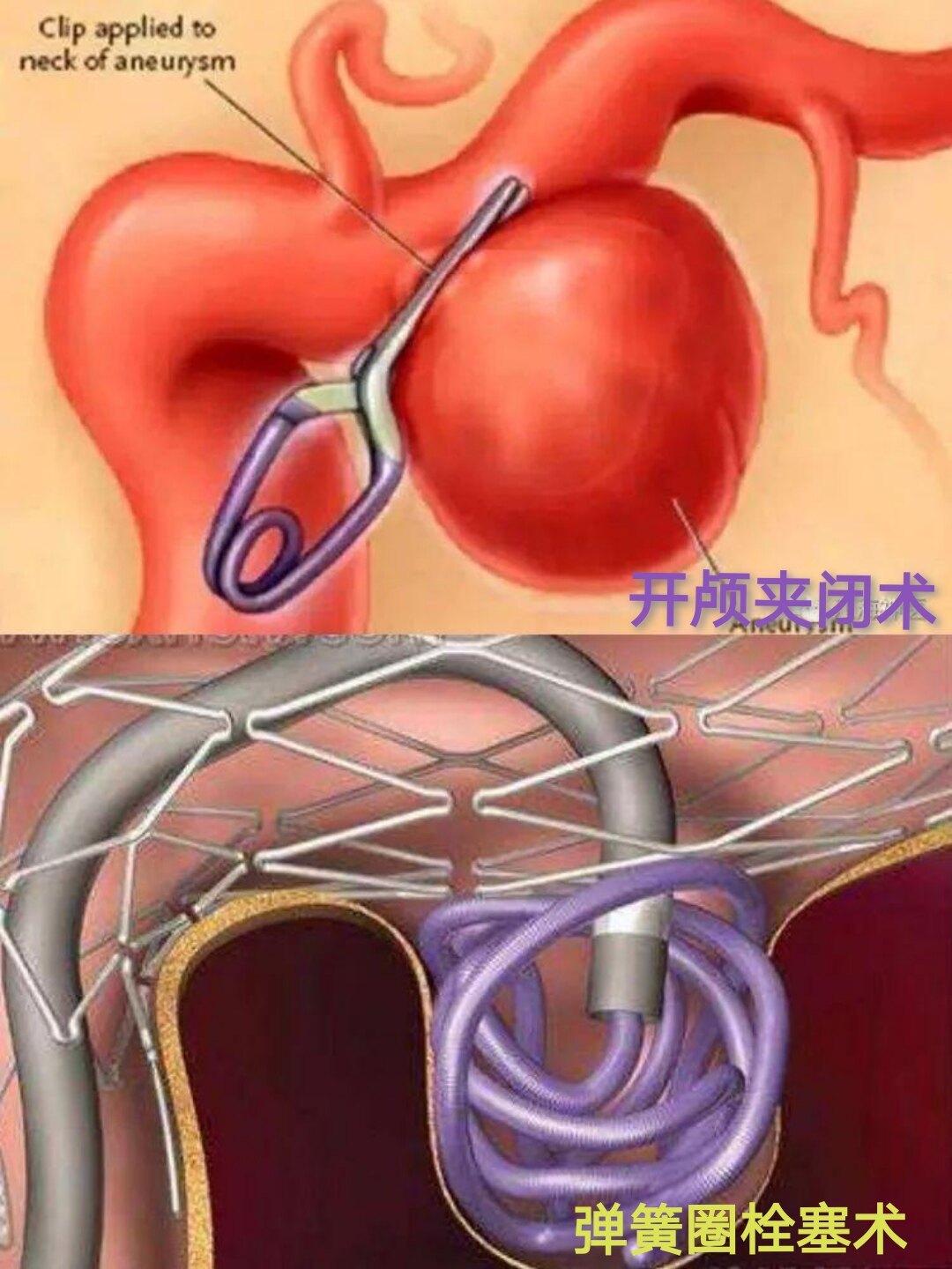 血流导向装置治疗脑动脉瘤的优势_脑动脉瘤_介绍_治疗方式 好大夫