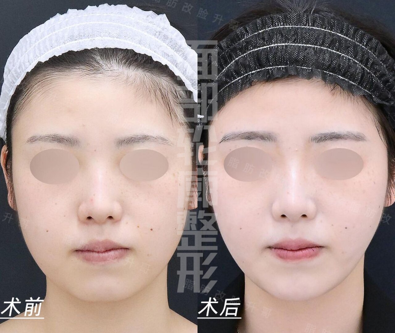 面部吸脂案例 - 好大夫在线